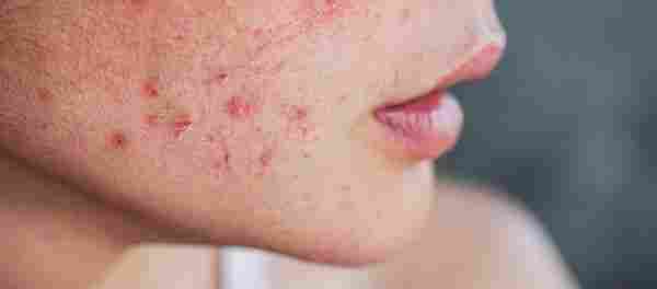 ACNE PRONE SKIN